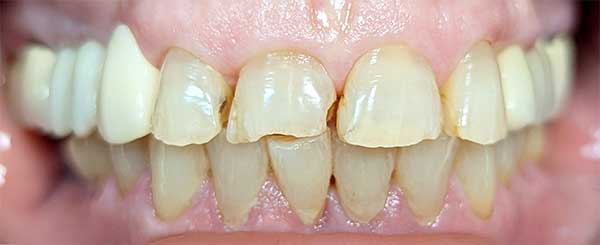 before and after case 1 - before