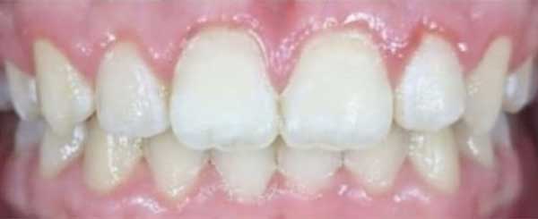 before and after case 4 - after